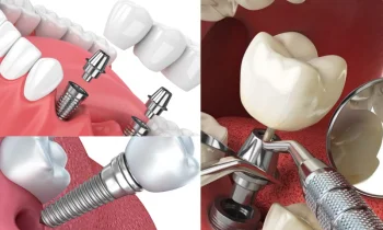 Düzce İmplant Nedir ve Kimler İçin Uygundur?