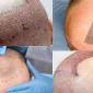Türkiye'de Saç Ekimi - زراعة الشعر في تركيا Nerede Vardır?
