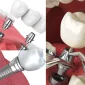 Düzce İmplant Nedir ve Kimler İçin Uygundur?