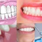 Diş Apsesi Nedir ve Yayılması