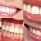 Kusursuz Bir Gülümseme Hayali Olanlara, Lamine Diş Tedavisi